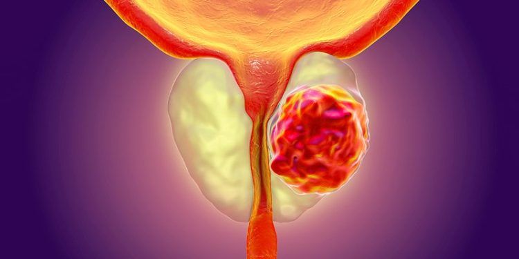 5 Prostate cancer facts a Ghanaian Man should know