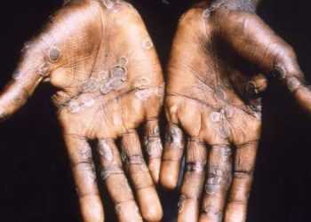Ghana records first cases of Monkeypox