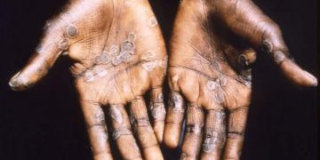 Ghana records first cases of Monkeypox
