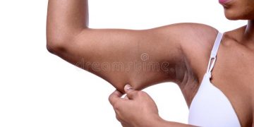 4 main causes of loose skin and how to avoid loose skin after weight loss