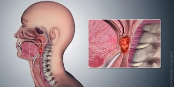 Does oral sex cause throat cancer?