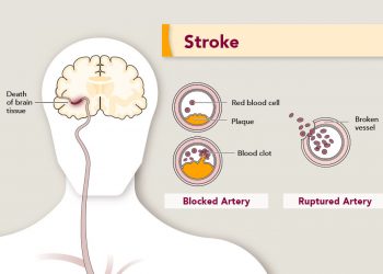 7 Tips For Choosing A Long-term Care Facility For Stroke Patients