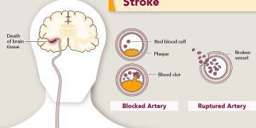 7 Tips For Choosing A Long-term Care Facility For Stroke Patients
