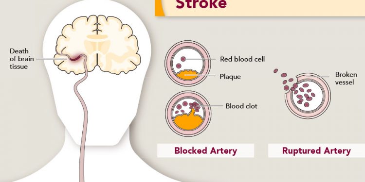 7 Tips For Choosing A Long-term Care Facility For Stroke Patients