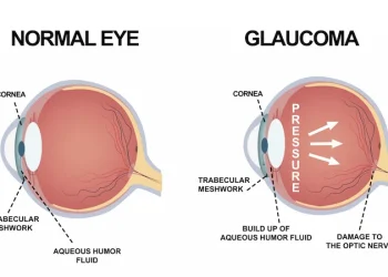 Understanding Glaucoma : Symptoms, Types, and Prevention