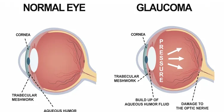 Understanding Glaucoma : Symptoms, Types, and Prevention