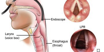 What Is Laryngopharyngeal Reflux (LPR)? Tips to Prevent It