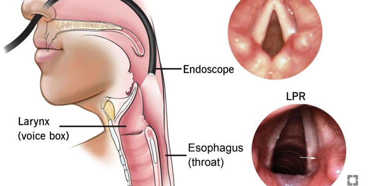 What Is Laryngopharyngeal Reflux (LPR)? Tips to Prevent It