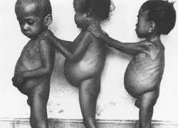 Understanding the Enigma of Protein Malnutrition