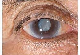 Understanding and Confronting Glaucoma