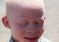 Understanding Albinism